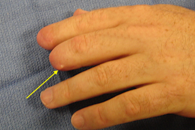 Amputation Finger Hand Surgery Source